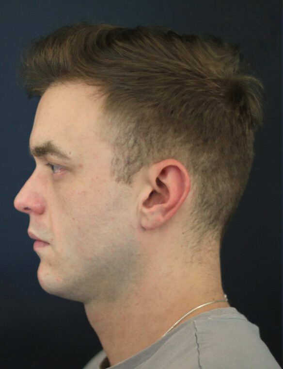 1c-after After Cosmetic