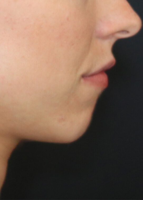 health ageing well chin jawline example 3