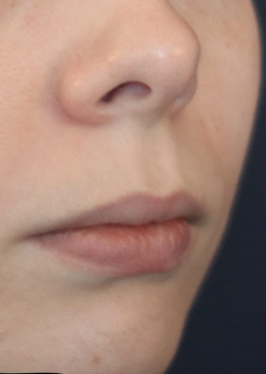 Lip Fillers & Augmentation in Edinburgh Dr Nestor