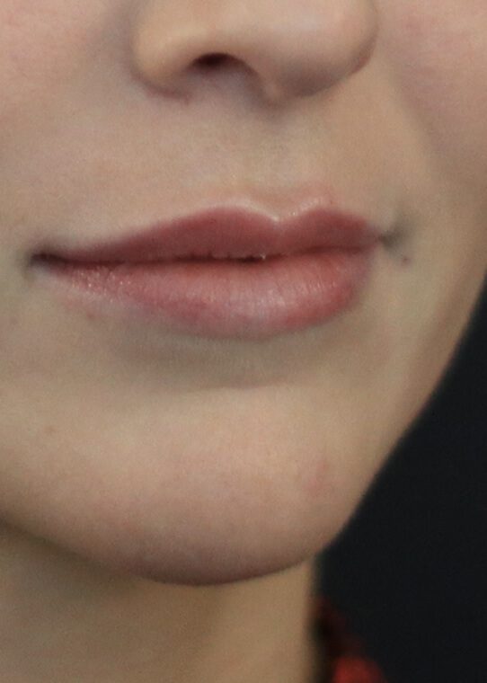 Lip Fillers & Augmentation in Edinburgh Dr Nestor