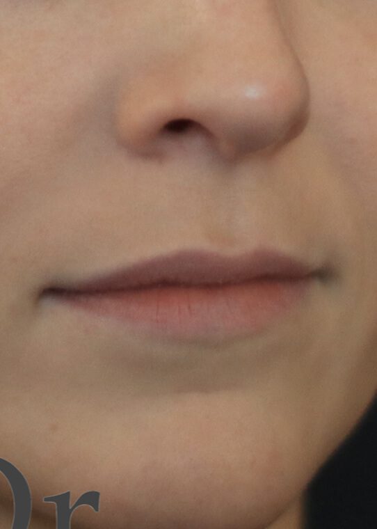Lip Fillers & Augmentation in Edinburgh Dr Nestor
