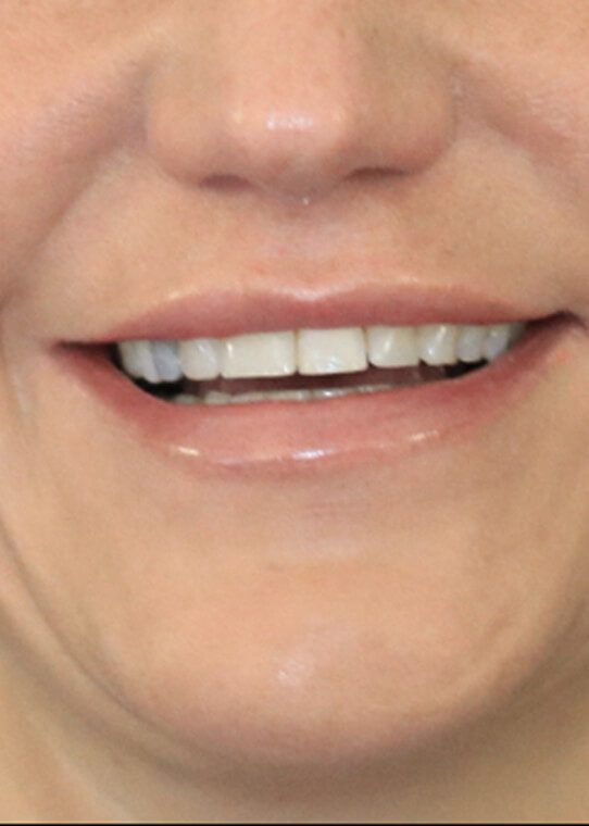 Lip Fillers & Augmentation in Edinburgh Dr Nestor