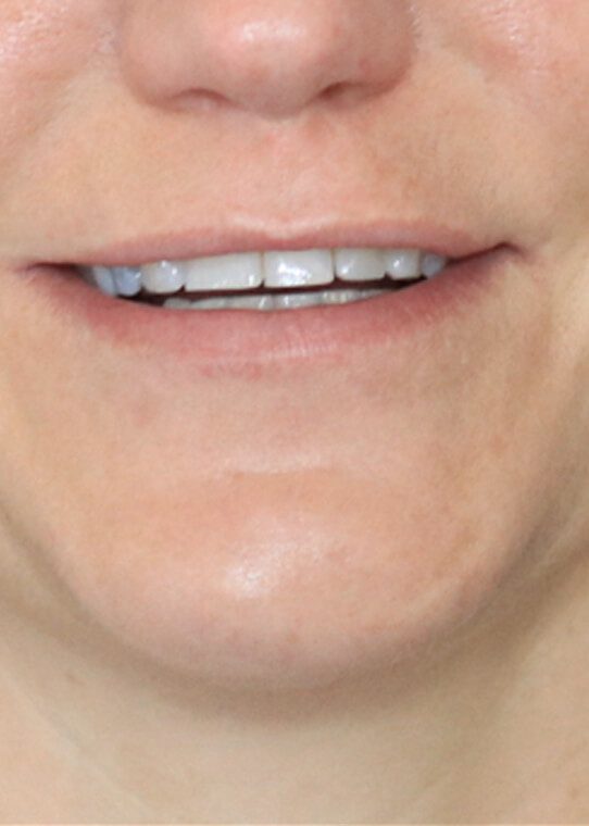 Lip Fillers & Augmentation in Edinburgh Dr Nestor