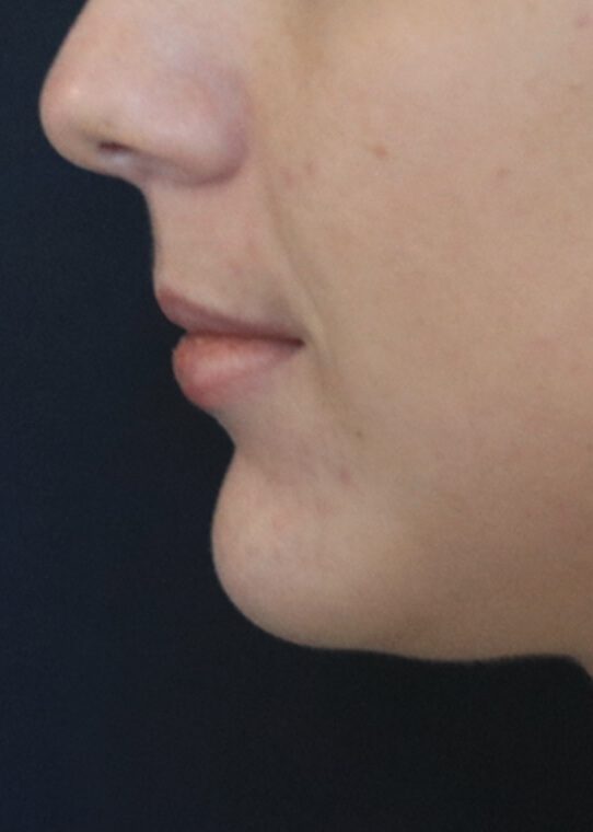 Lip Fillers & Augmentation in Edinburgh Dr Nestor