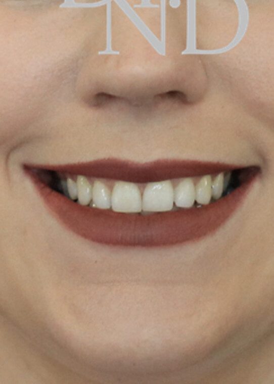 Lip Fillers & Augmentation in Edinburgh Dr Nestor