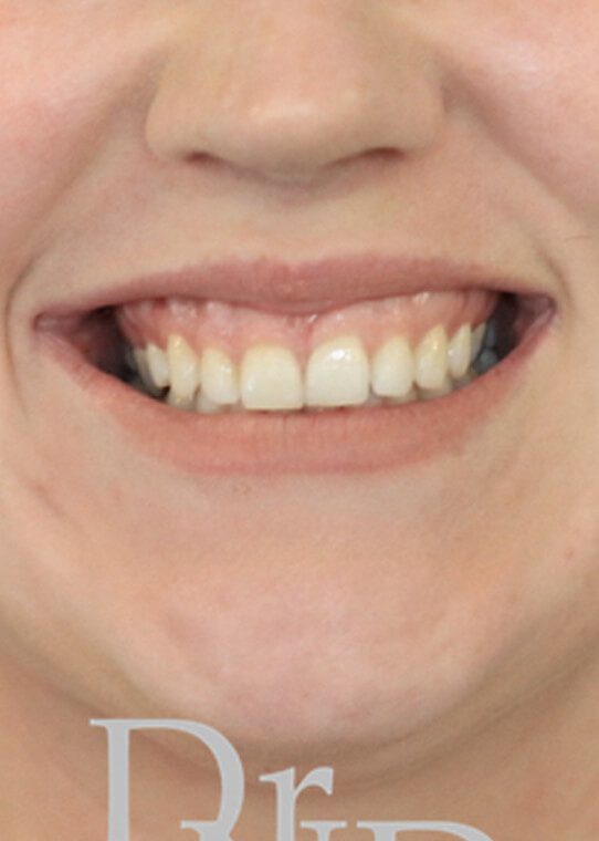 Lip Fillers & Augmentation in Edinburgh Dr Nestor