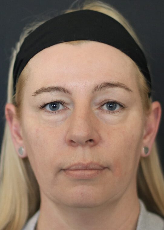 health ageing well mid face example 2 health ageing well mid face example 2