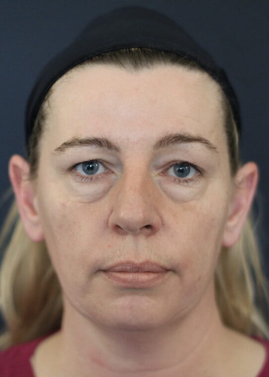 health ageing well mid face example 2 health ageing well mid face example 2