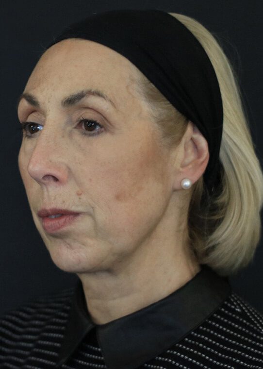 dr-nestor-medical-and-cosmetics-centre-womans-health-ageing-well-mid-face-example-4-after Wrinkle Treatment