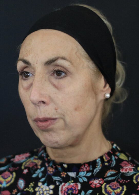 dr-nestor-medical-and-cosmetics-centre-womans-health-ageing-well-mid-face-example-4-after Wrinkle Treatment