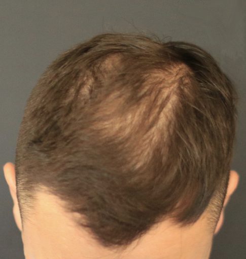 Hair Loss Hair Loss