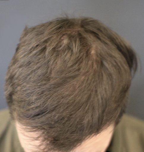 Hair Loss Hair Loss