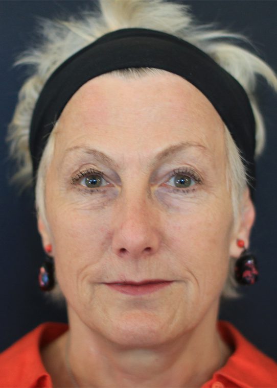 dr-nestor-medical-cosmetics-centre-before&after-b2 Cosmetic before after