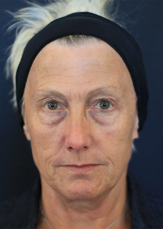 dr-nestor-medical-cosmetics-centre-before&after-b2 Cosmetic before after