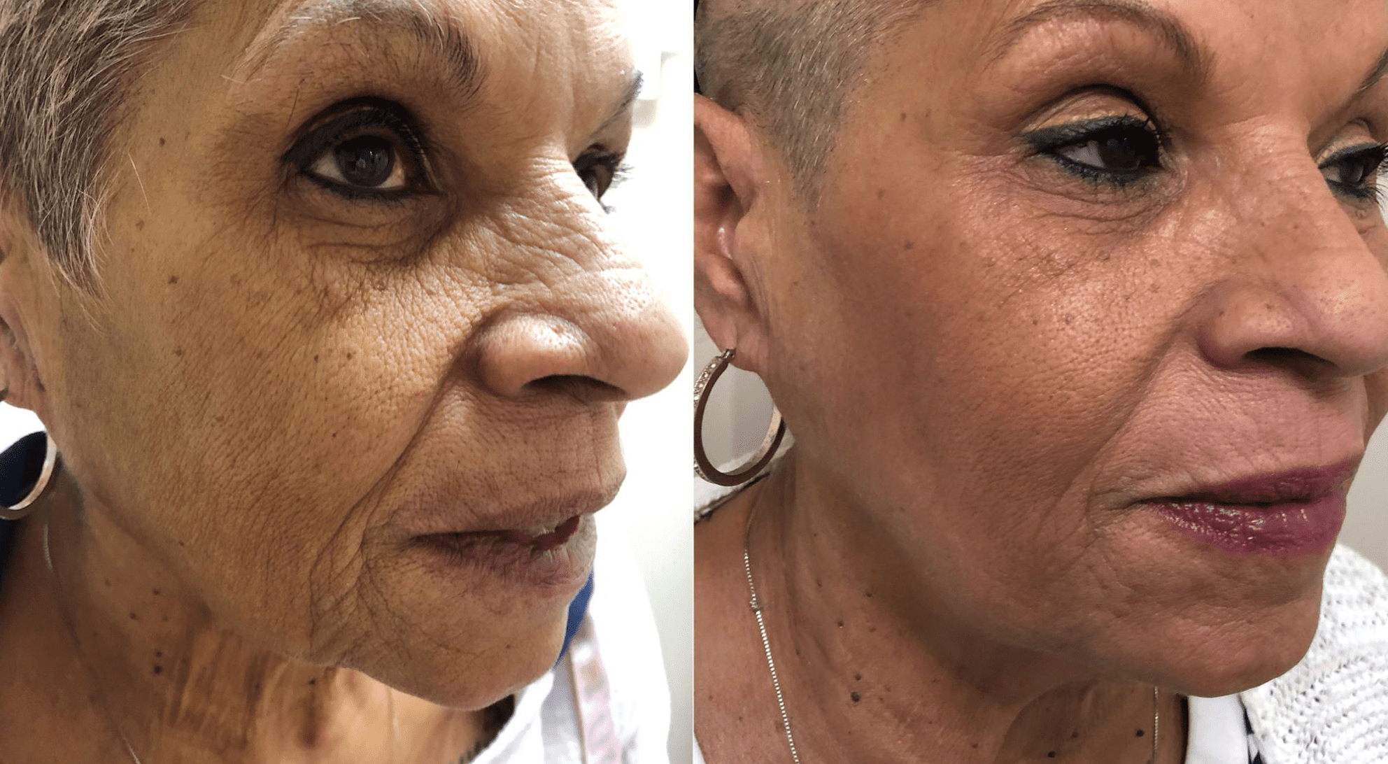 aging pigmentation